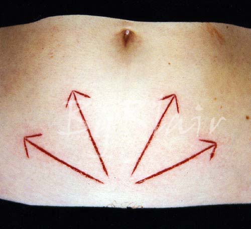 CUTTING