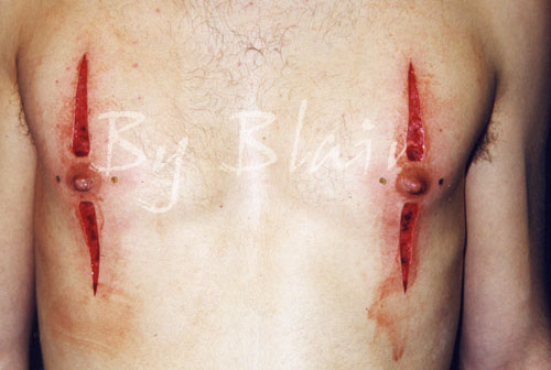 Skin Peels