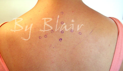 Skin Peels